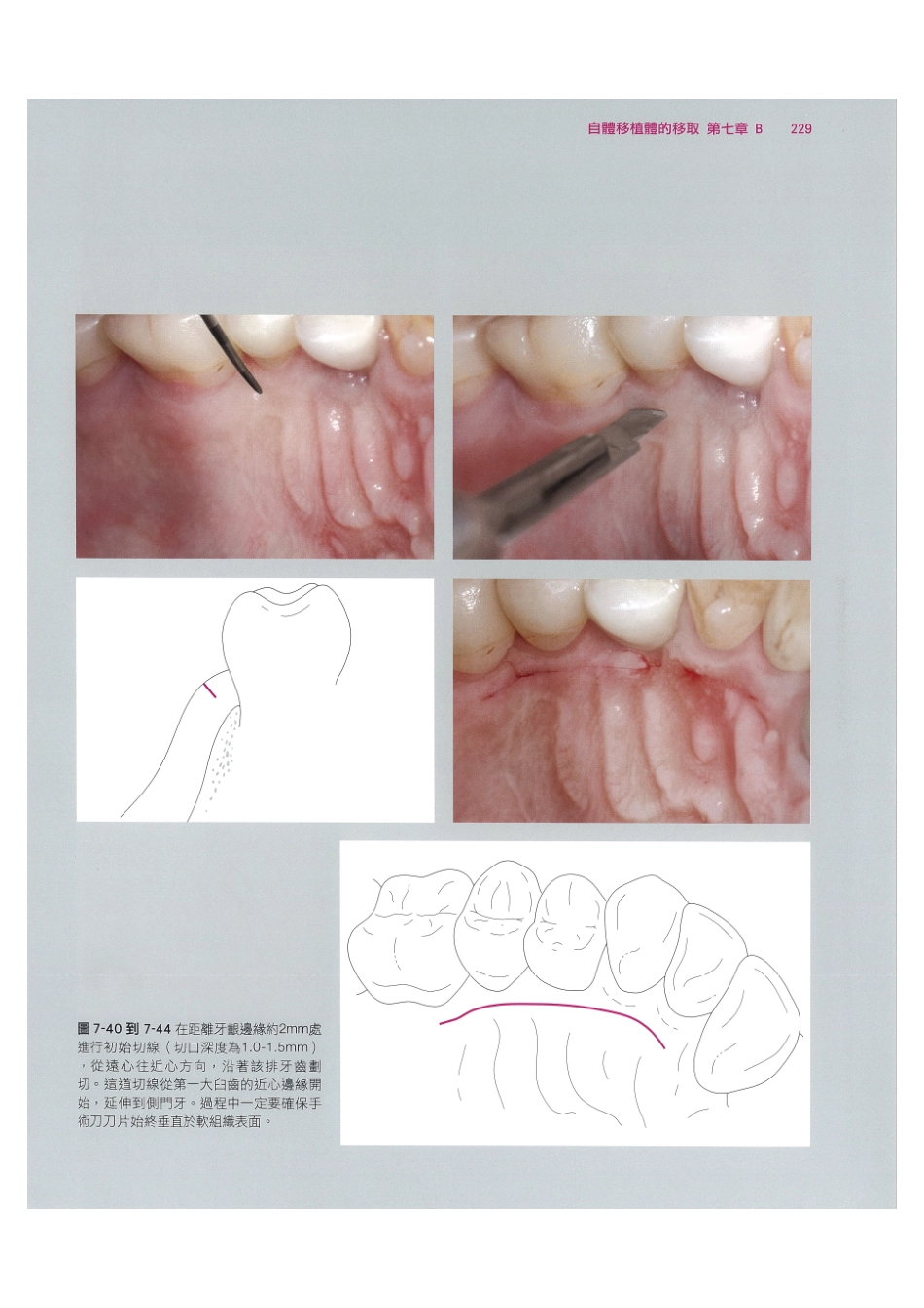 179.牙周整形美容与种植手术_241-248.pdf_第3页