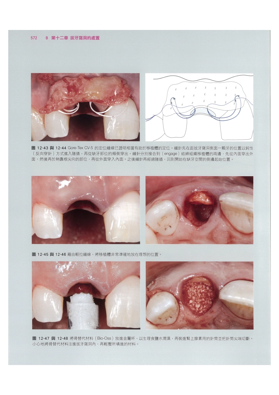 179.牙周整形美容与种植手术_585-592.pdf_第2页