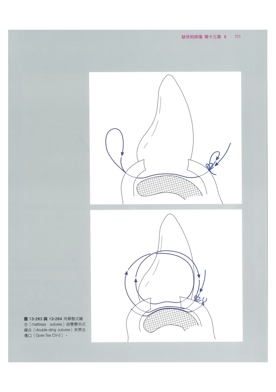 179.牙周整形美容与种植手术_785-792.pdf_第1页
