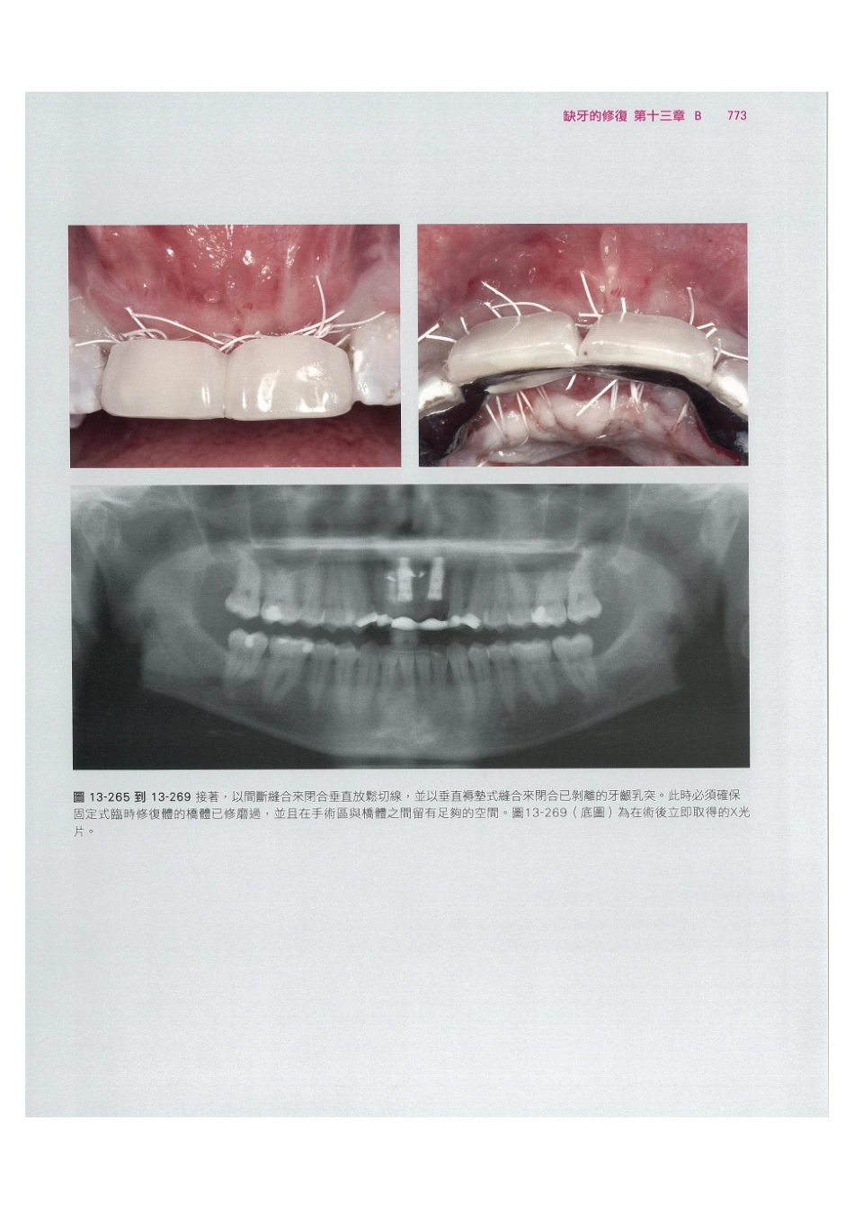 179.牙周整形美容与种植手术_785-792.pdf_第3页