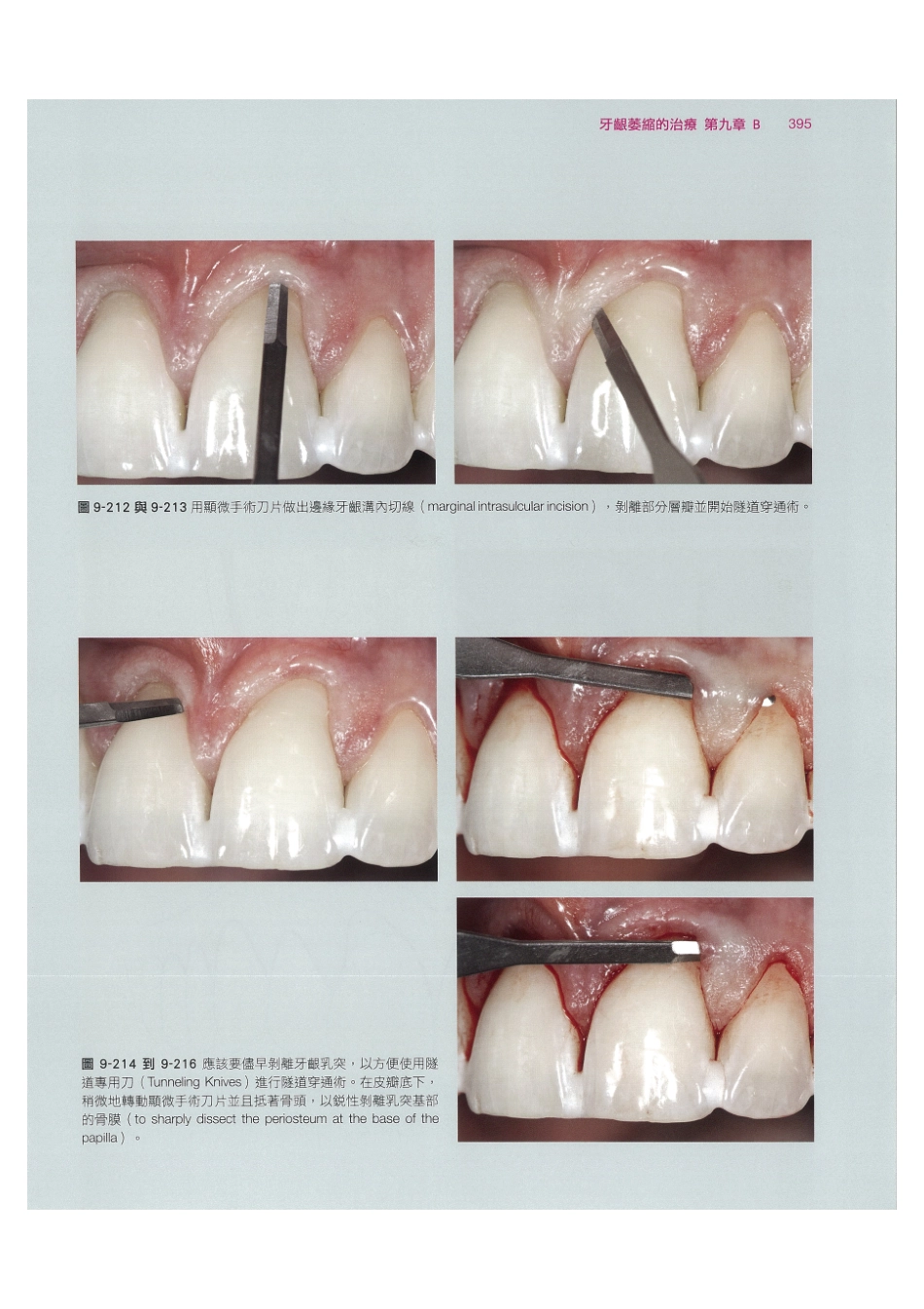 179.牙周整形美容与种植手术_409-416.pdf_第1页