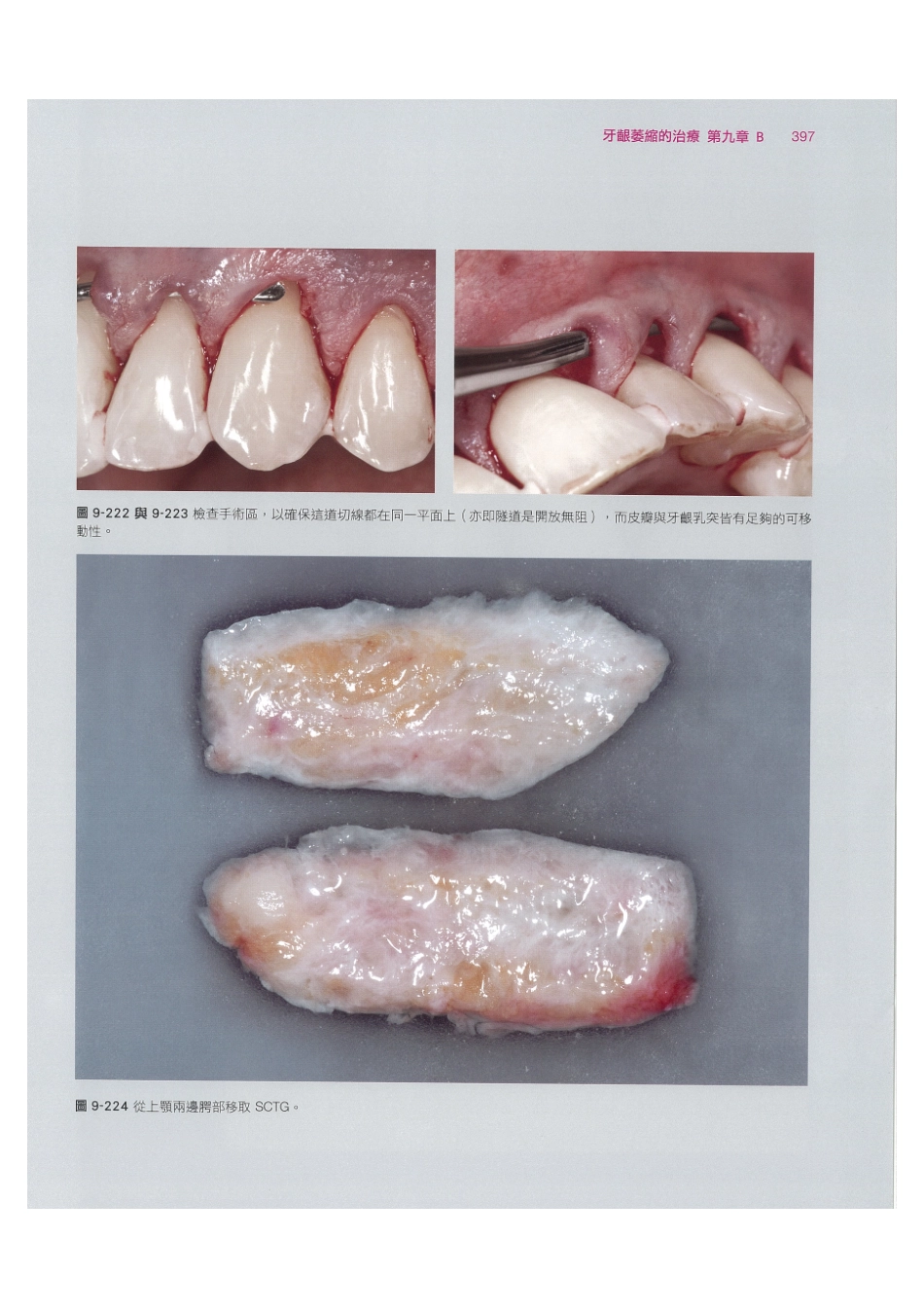 179.牙周整形美容与种植手术_409-416.pdf_第3页