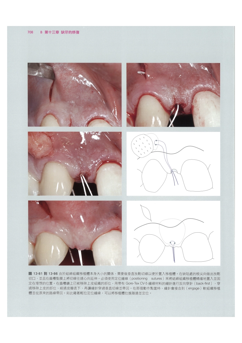 179.牙周整形美容与种植手术_721-728.pdf_第2页
