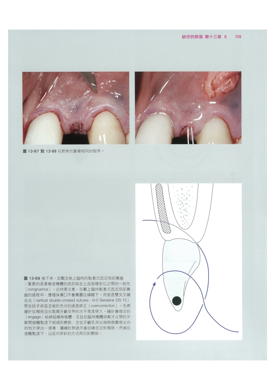 179.牙周整形美容与种植手术_721-728.pdf_第3页