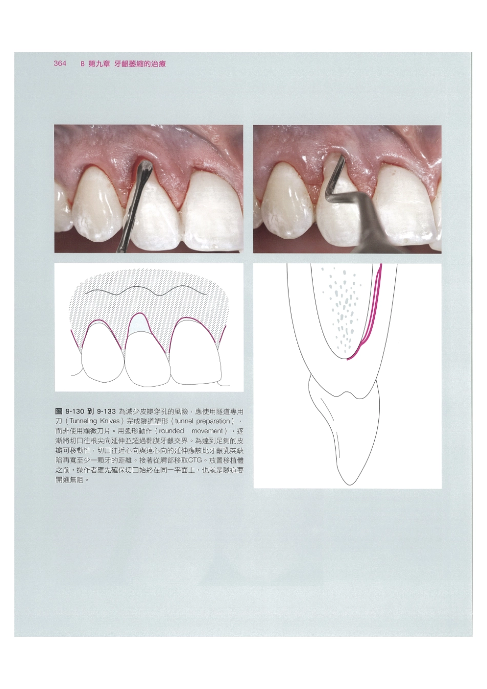 179.牙周整形美容与种植手术_377-384.pdf_第2页