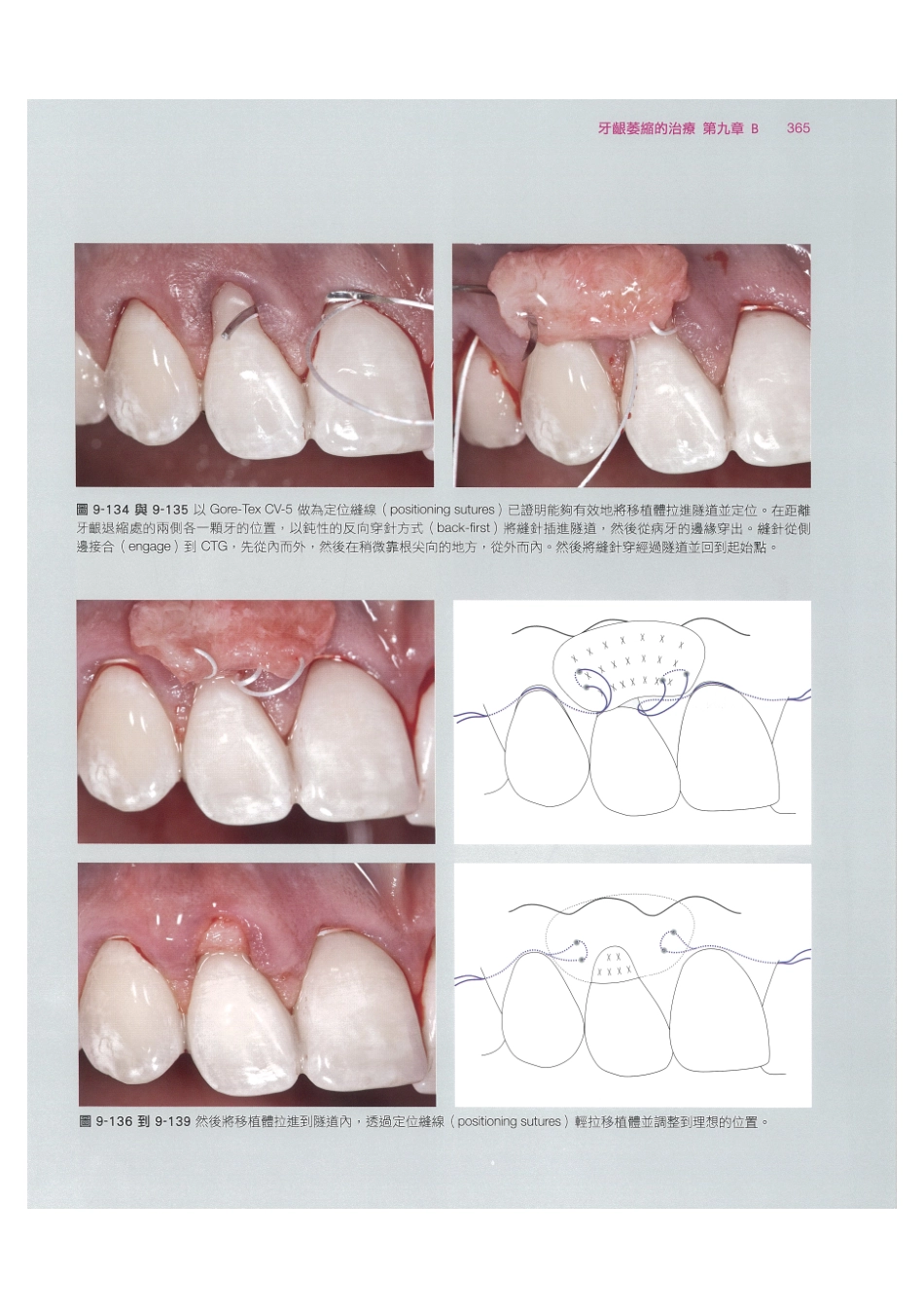 179.牙周整形美容与种植手术_377-384.pdf_第3页