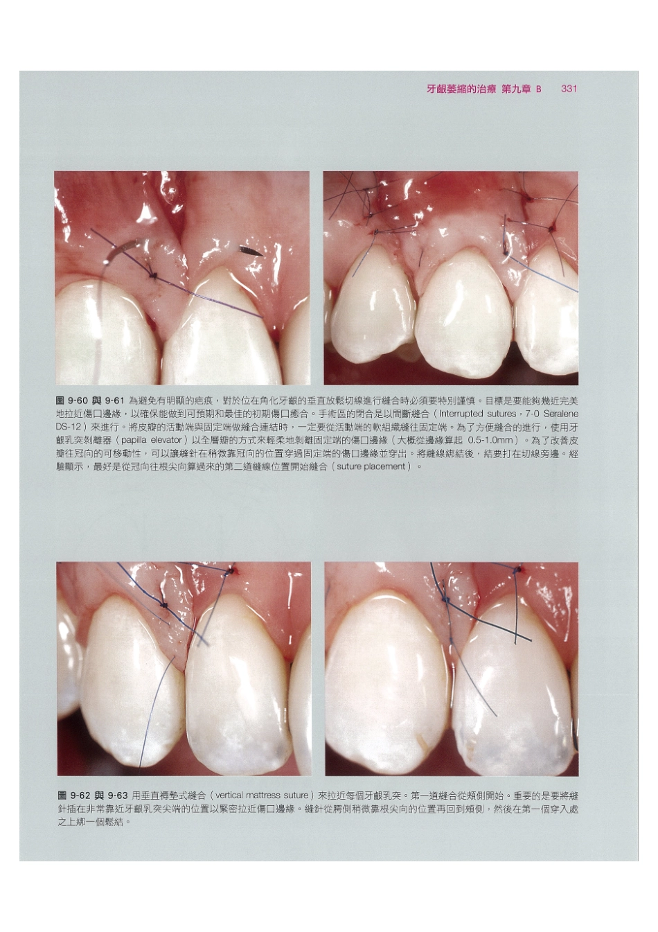 179.牙周整形美容与种植手术_345-352.pdf_第1页
