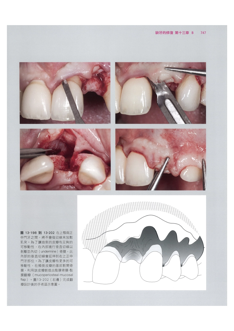 179.牙周整形美容与种植手术_761-768.pdf_第1页