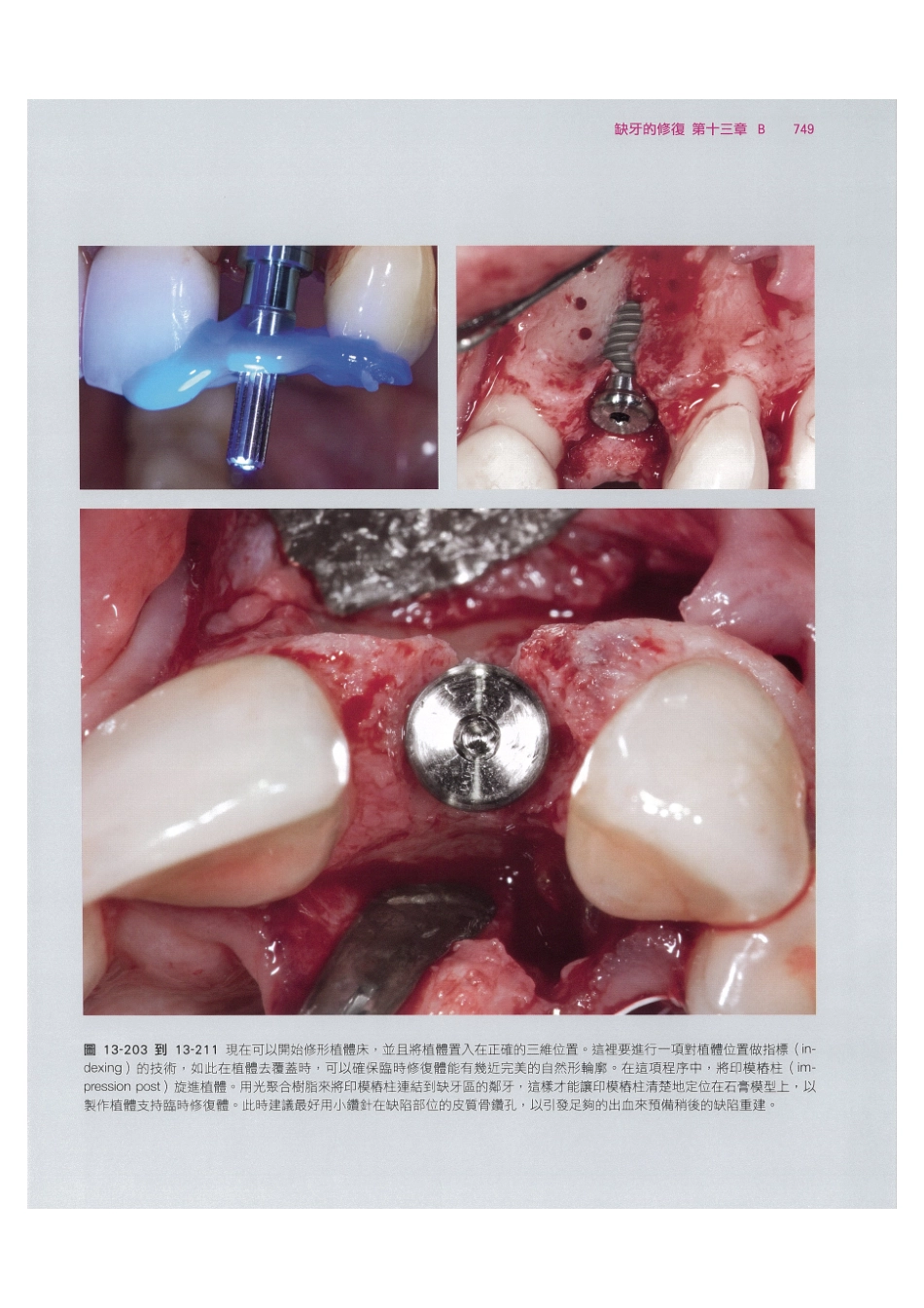 179.牙周整形美容与种植手术_761-768.pdf_第3页
