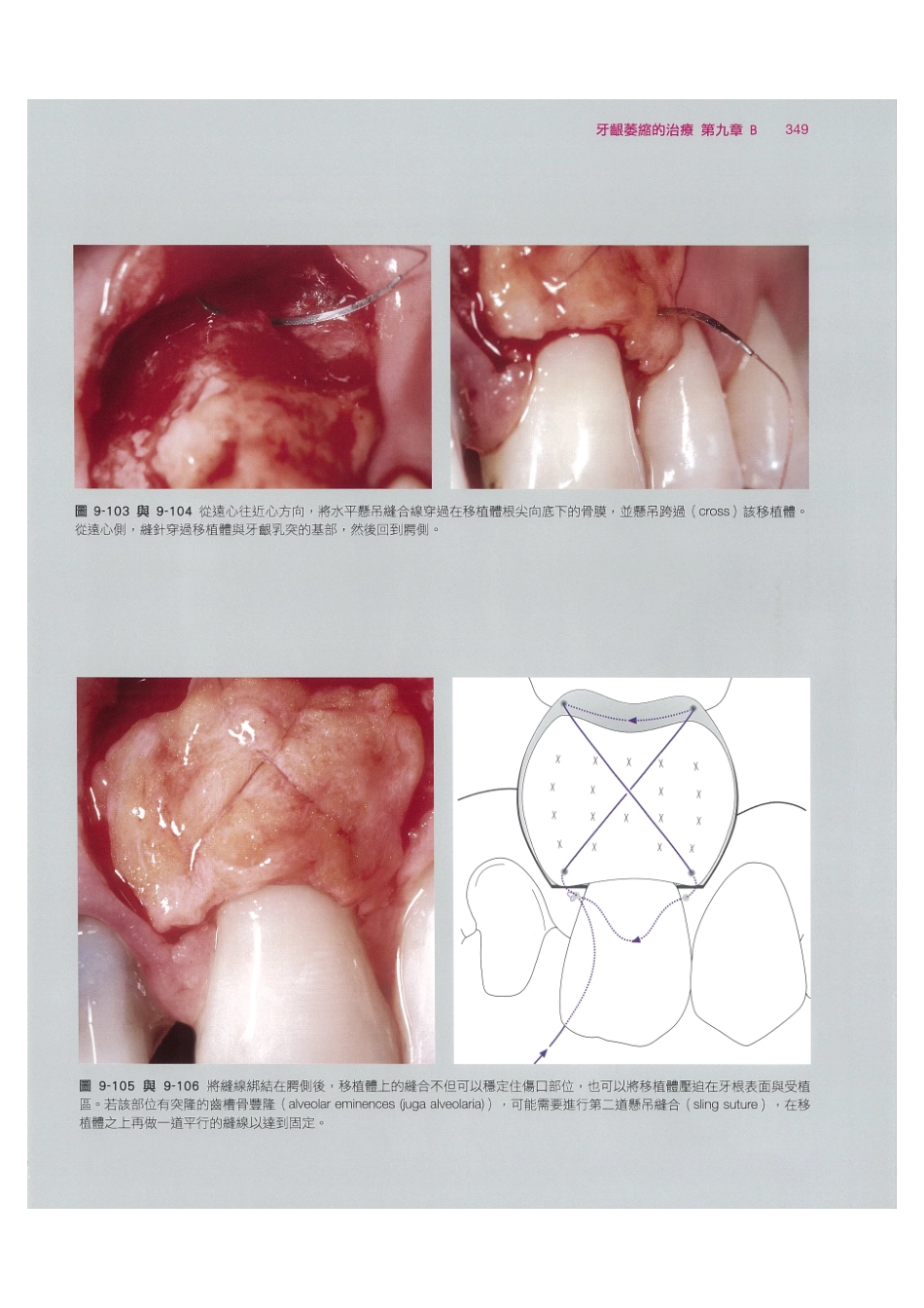 179.牙周整形美容与种植手术_361-368.pdf_第3页