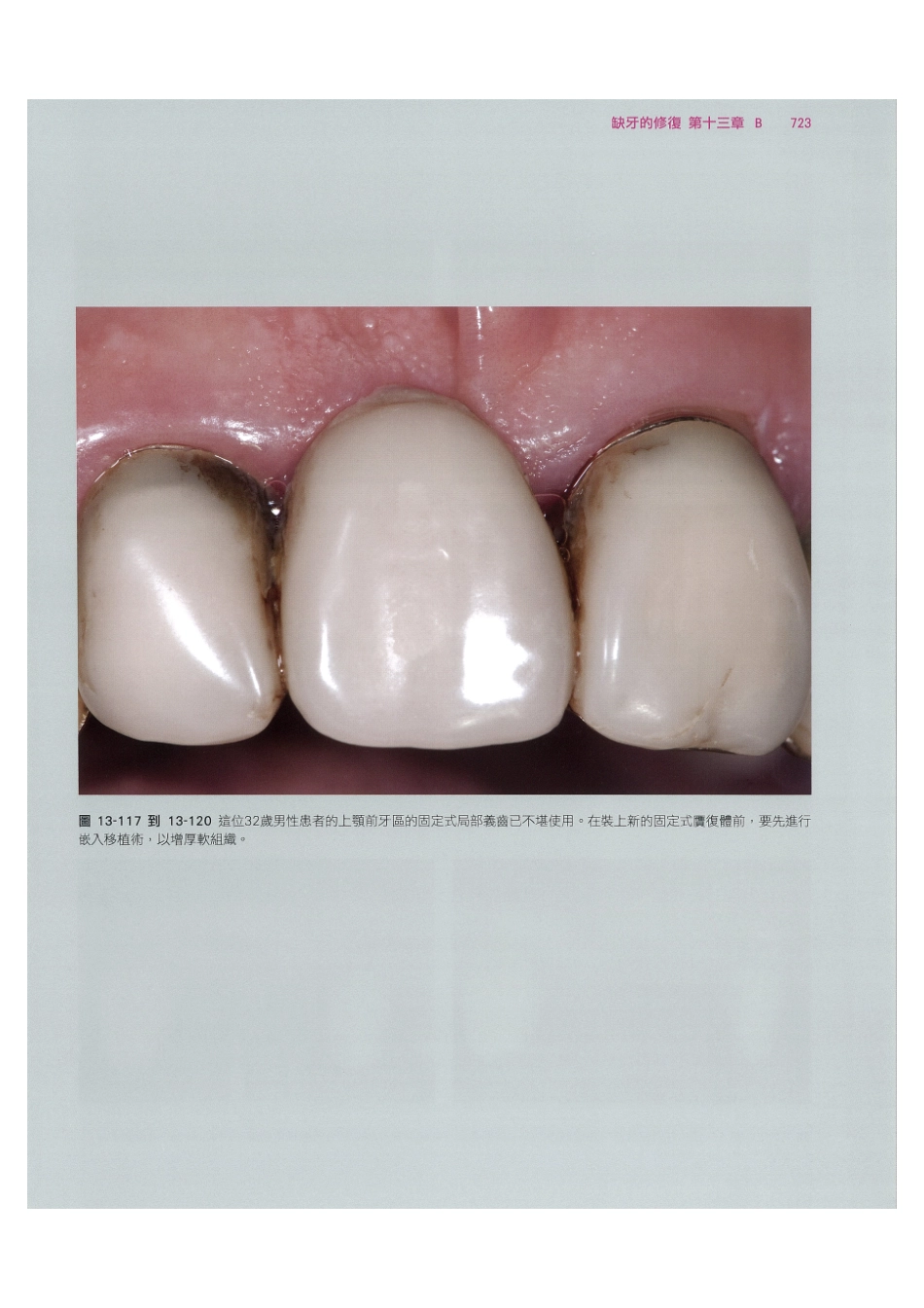 179.牙周整形美容与种植手术_737-744.pdf_第1页