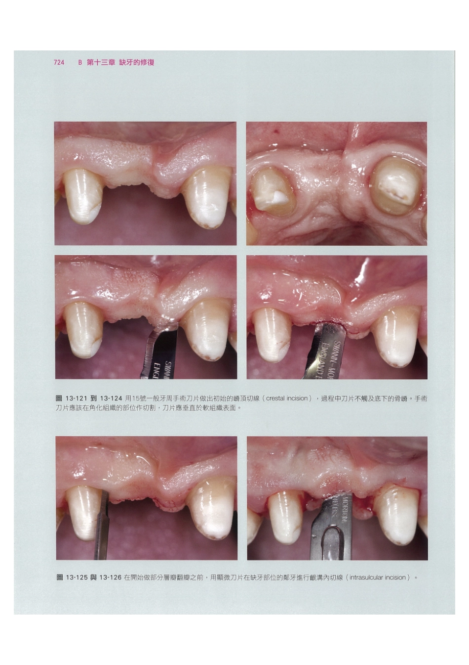 179.牙周整形美容与种植手术_737-744.pdf_第2页