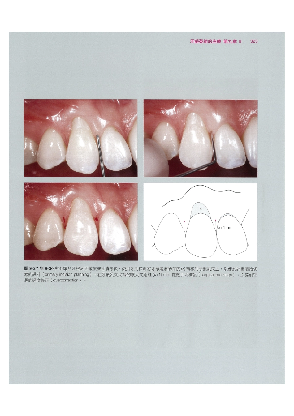 179.牙周整形美容与种植手术_337-344.pdf_第1页