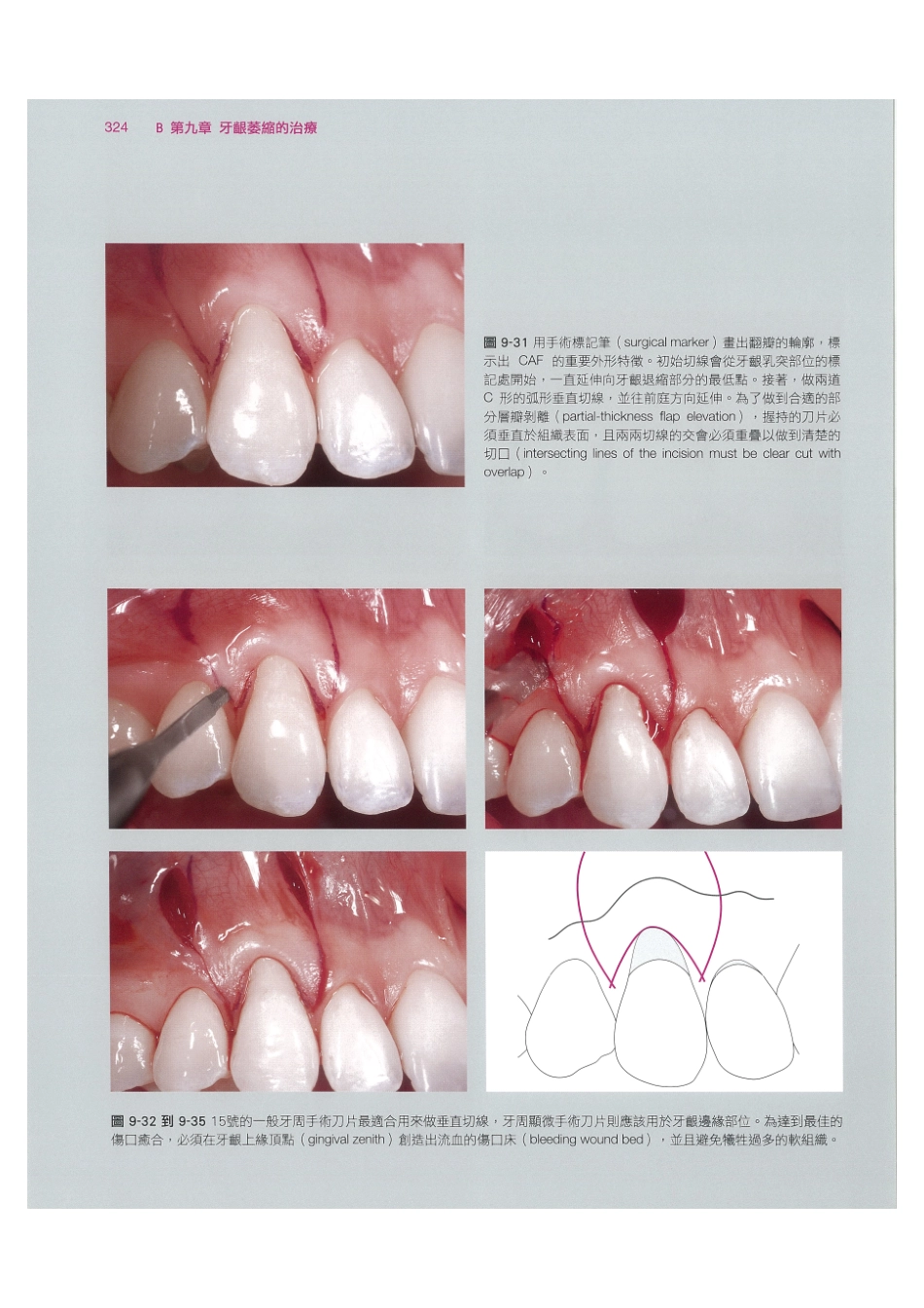 179.牙周整形美容与种植手术_337-344.pdf_第2页