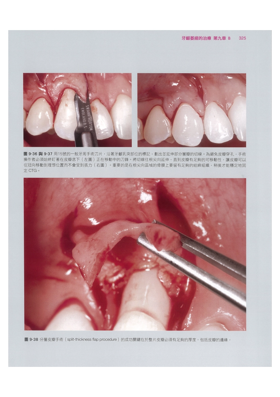 179.牙周整形美容与种植手术_337-344.pdf_第3页