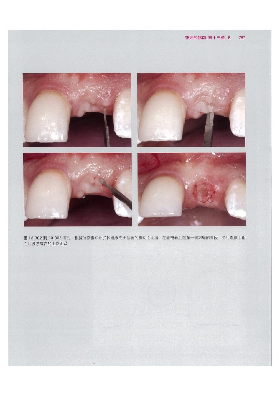 179.牙周整形美容与种植手术_801-808.pdf_第1页