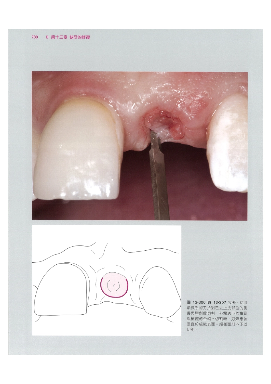 179.牙周整形美容与种植手术_801-808.pdf_第2页