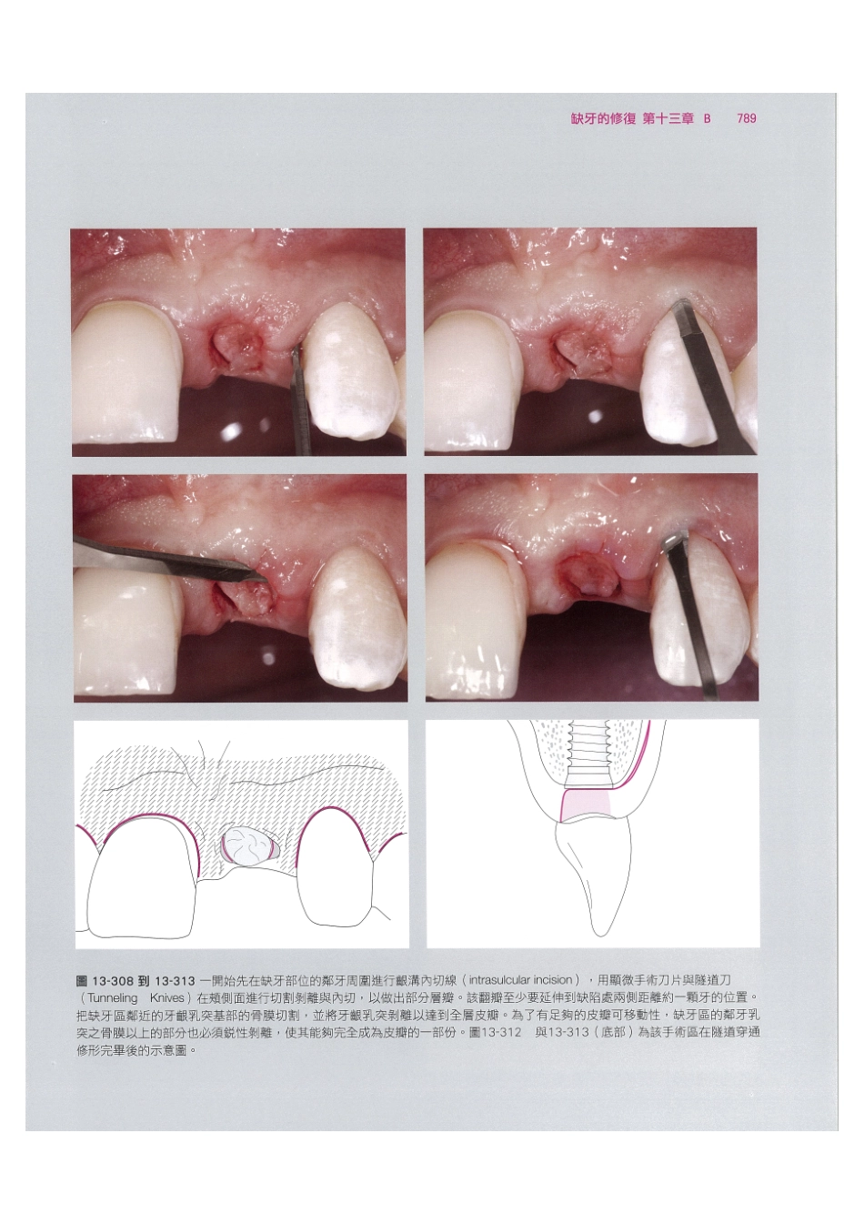179.牙周整形美容与种植手术_801-808.pdf_第3页