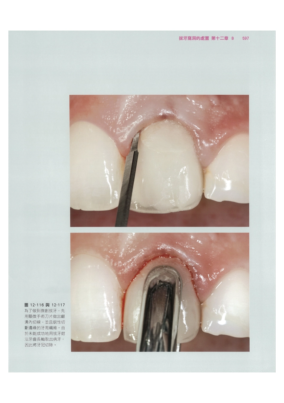 179.牙周整形美容与种植手术_609-616.pdf_第3页