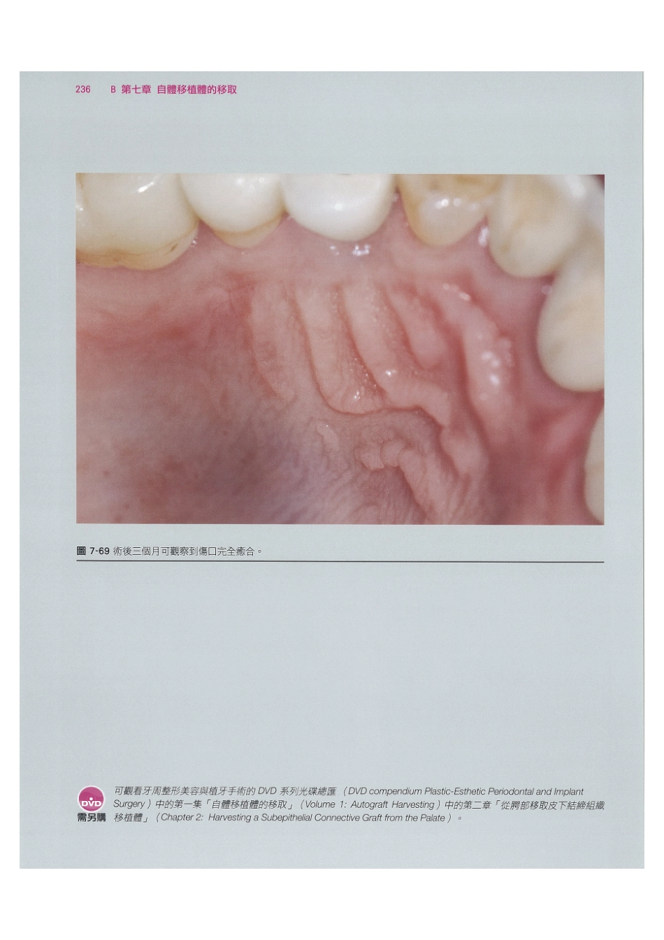 179.牙周整形美容与种植手术_249-256.pdf_第2页