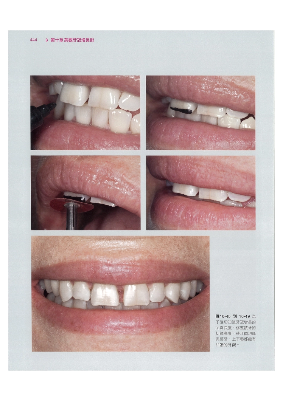 179.牙周整形美容与种植手术_457-464.pdf_第2页