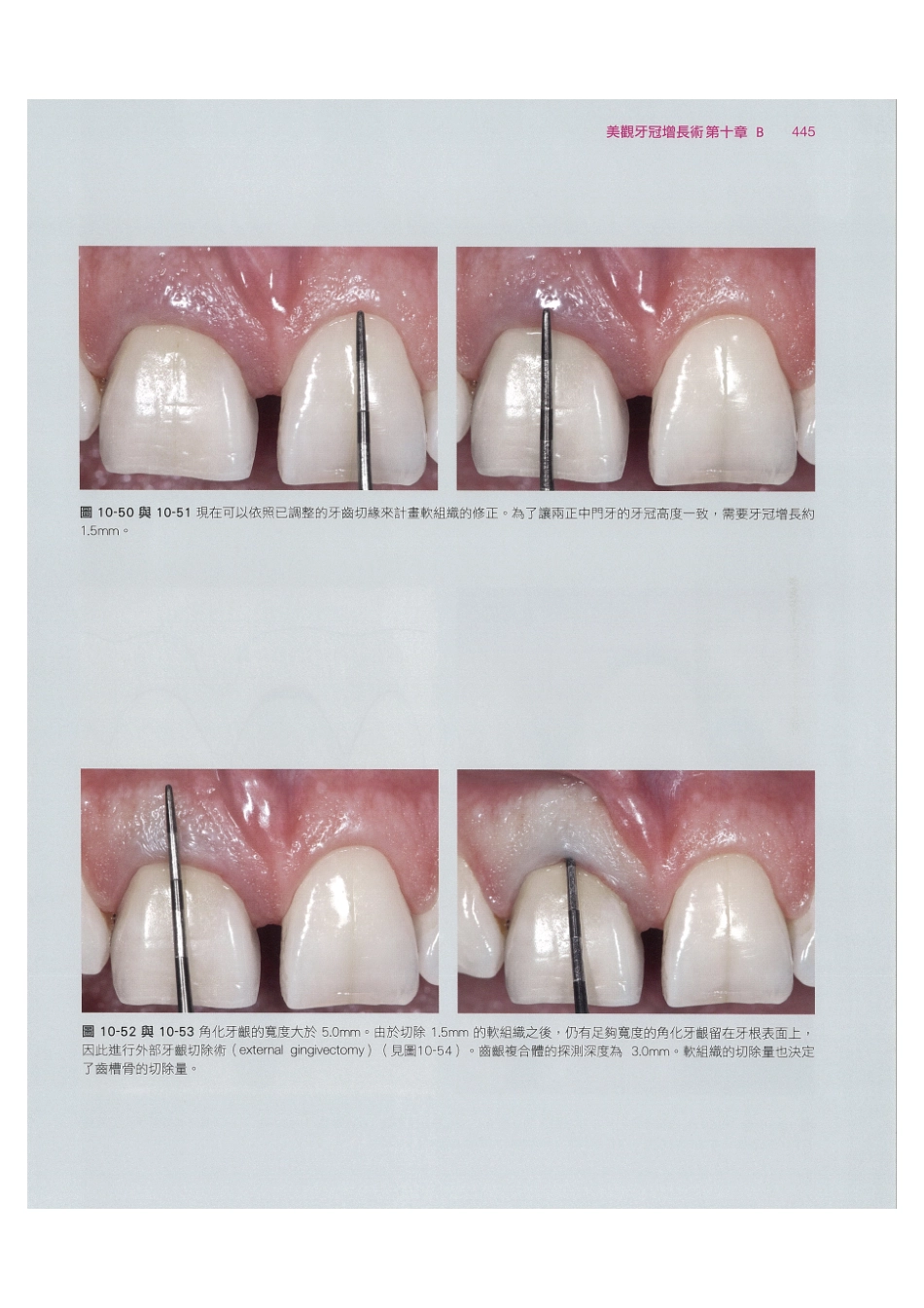 179.牙周整形美容与种植手术_457-464.pdf_第3页