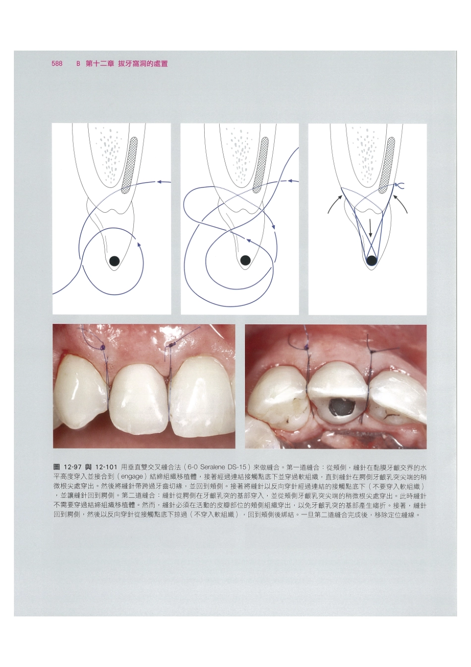179.牙周整形美容与种植手术_601-608.pdf_第2页