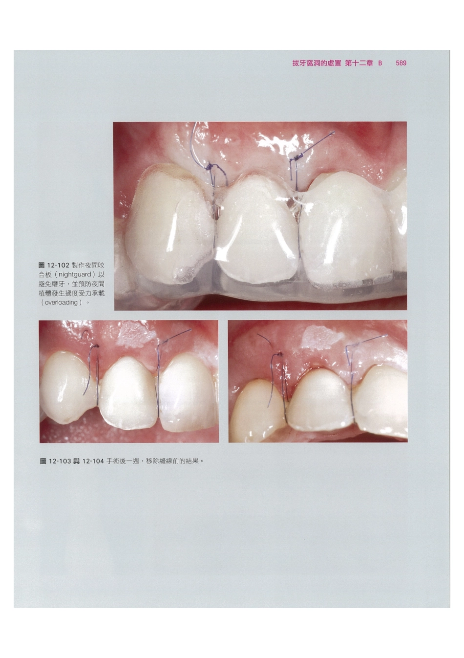 179.牙周整形美容与种植手术_601-608.pdf_第3页