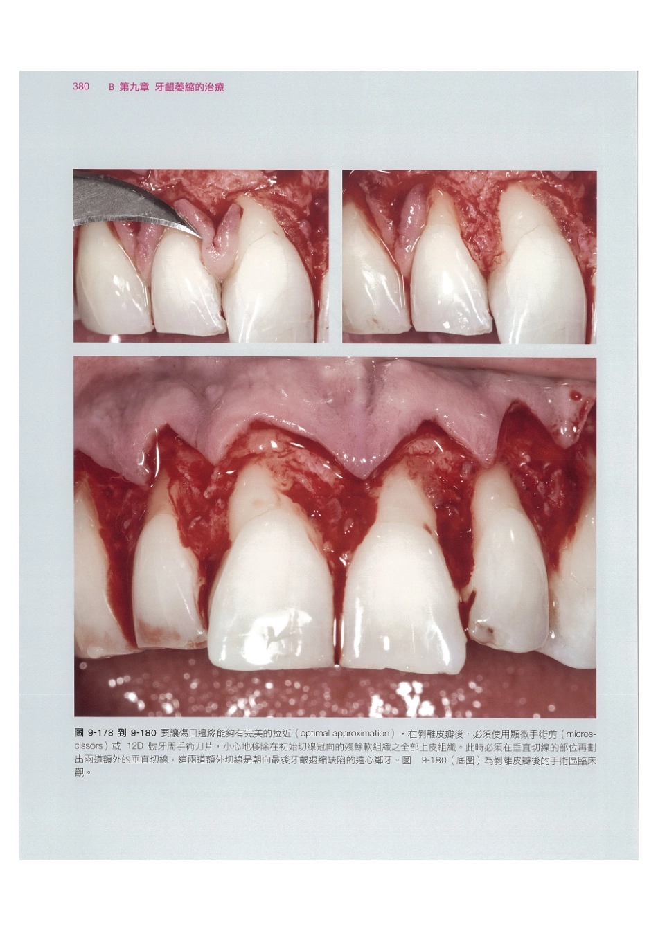 179.牙周整形美容与种植手术_393-400.pdf_第2页