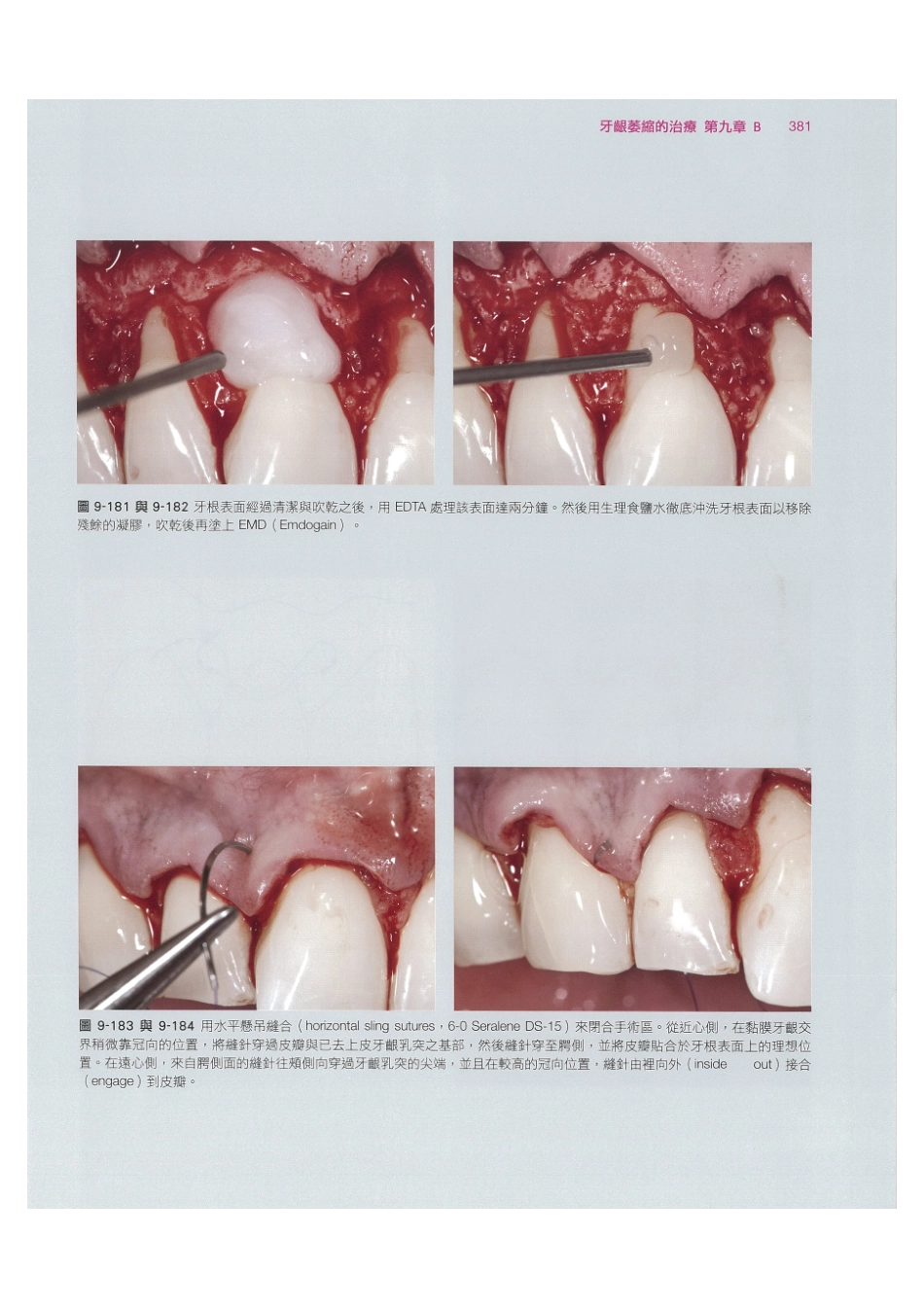 179.牙周整形美容与种植手术_393-400.pdf_第3页
