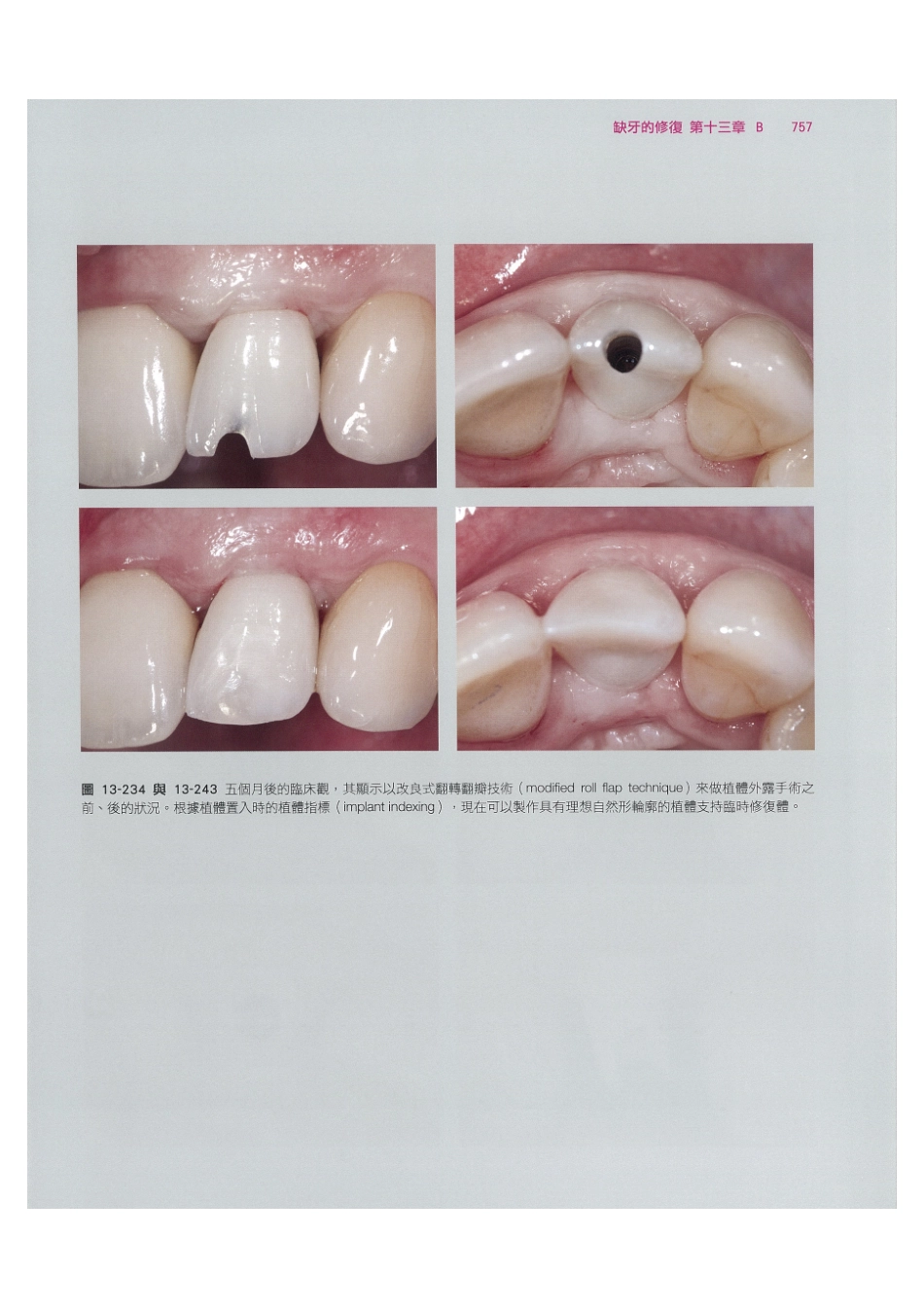179.牙周整形美容与种植手术_769-776.pdf_第3页