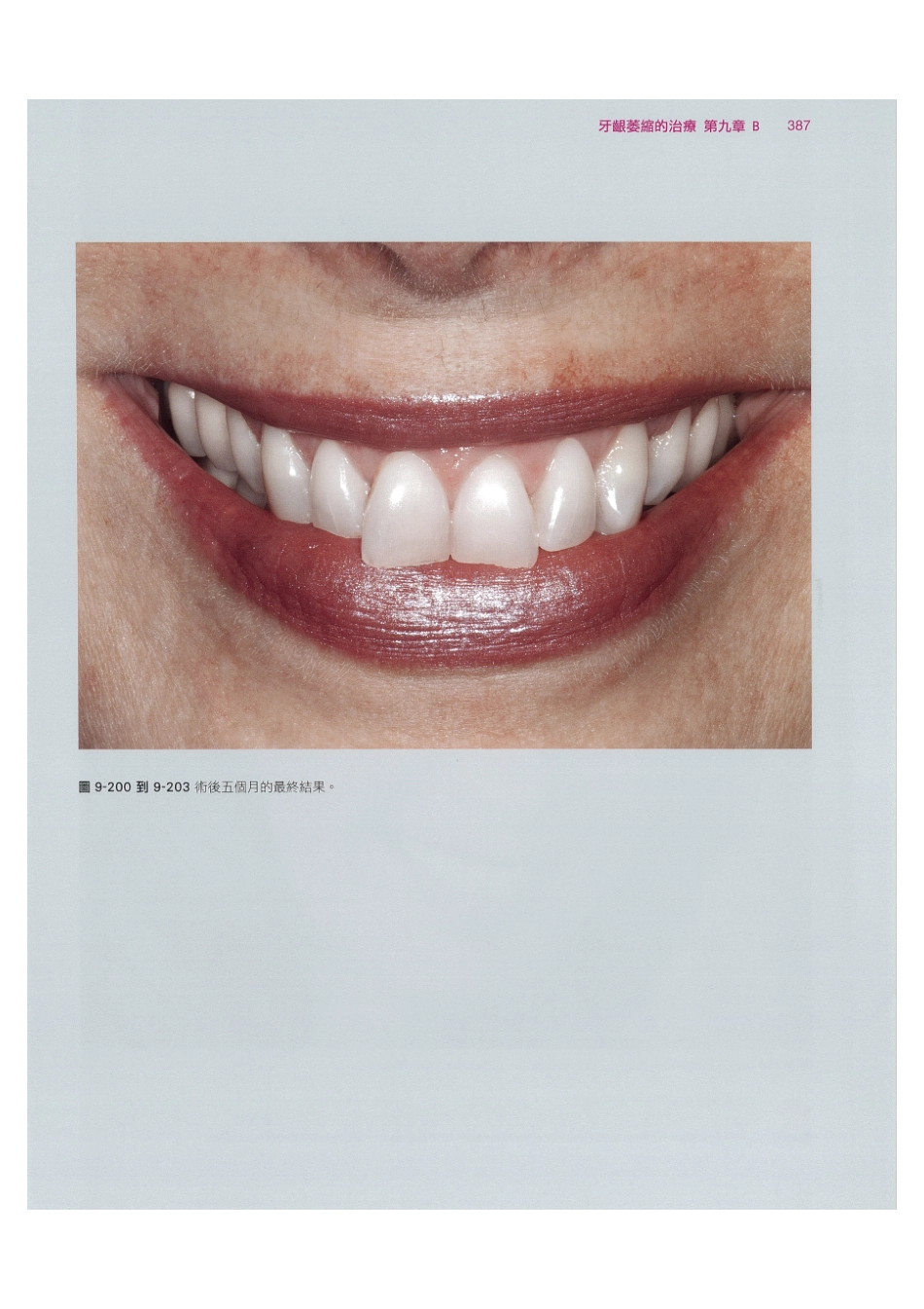 179.牙周整形美容与种植手术_401-408.pdf_第1页