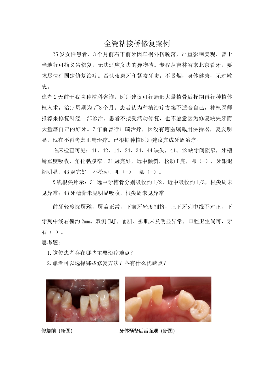 全瓷粘接桥修复案例.docx_第1页