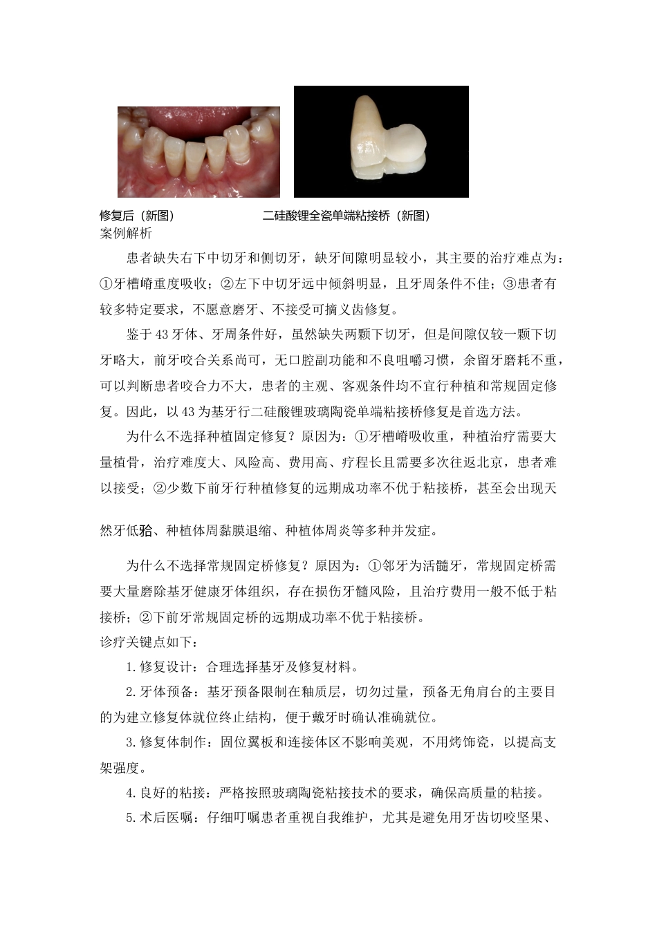 全瓷粘接桥修复案例.docx_第2页