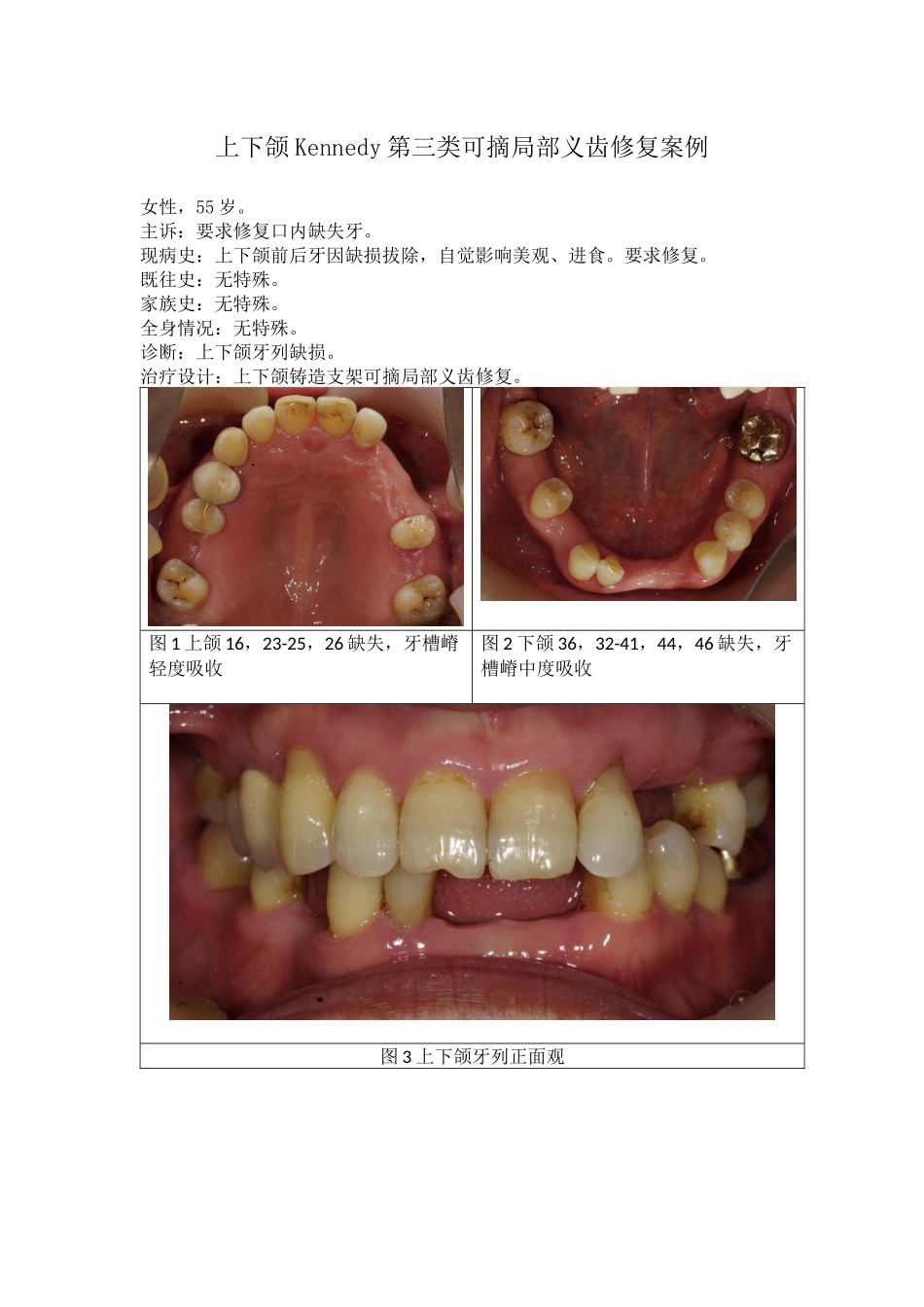 上下颌Kennedy第三类可摘局部义齿修复案例.docx_第1页