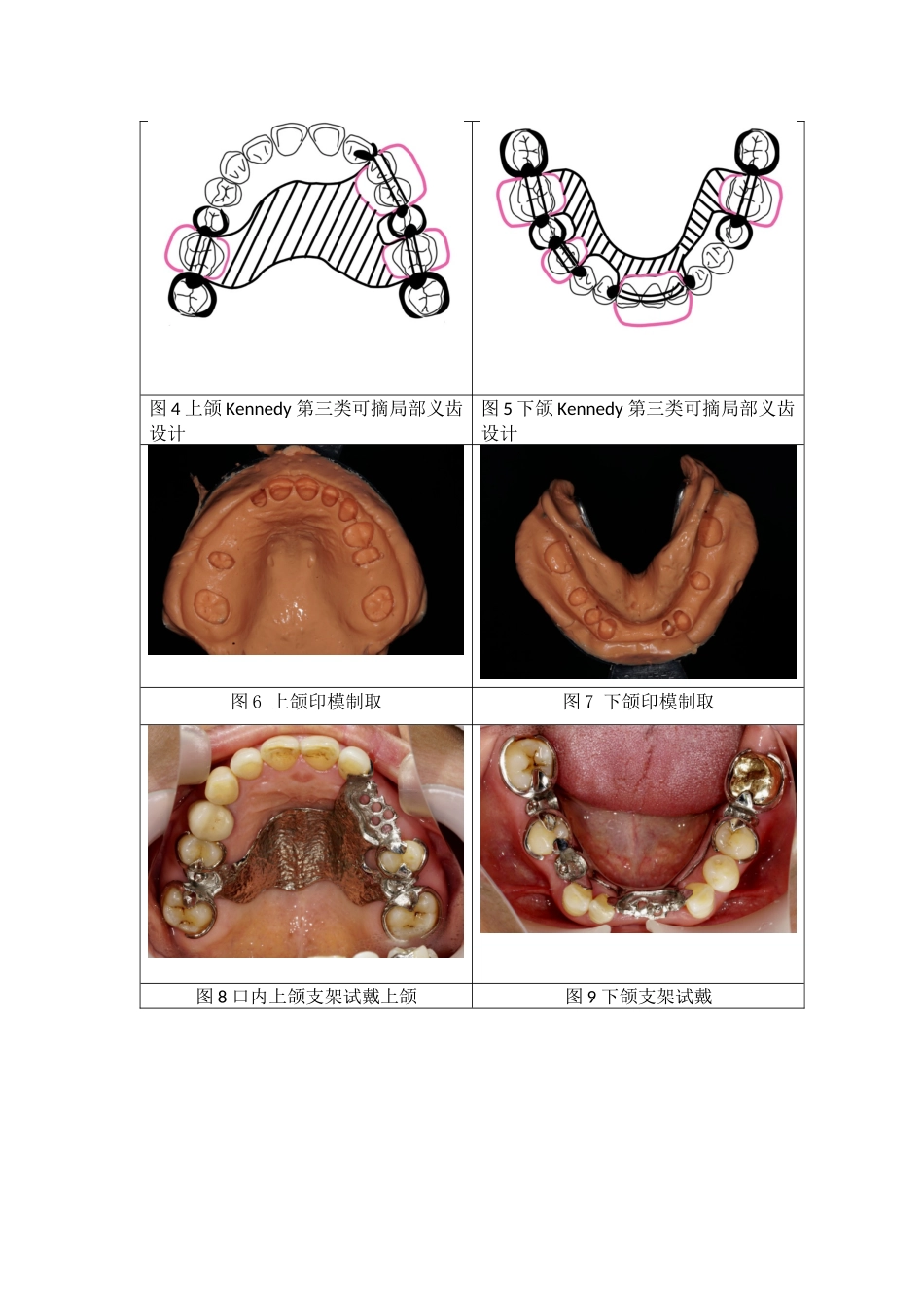 上下颌Kennedy第三类可摘局部义齿修复案例.docx_第2页