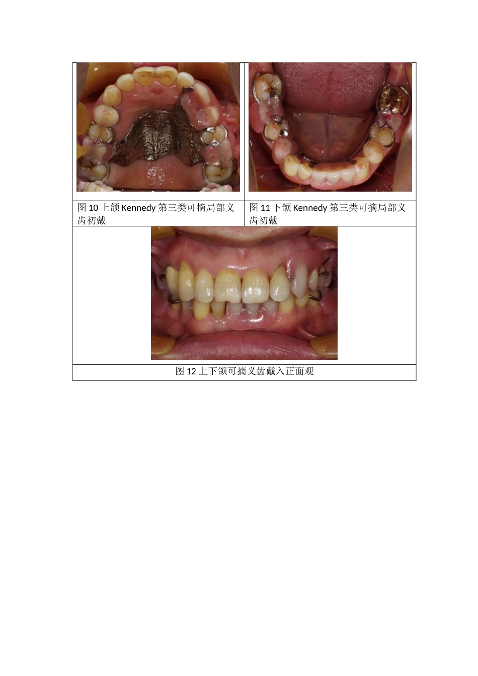 上下颌Kennedy第三类可摘局部义齿修复案例.docx_第3页