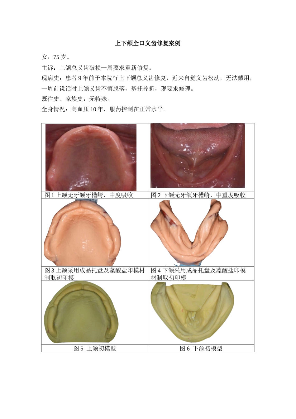 上下颌全口义齿修复案例.docx_第1页