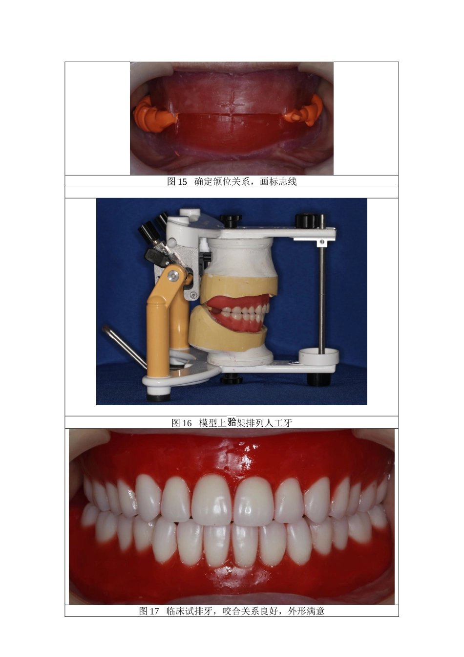 上下颌全口义齿修复案例.docx_第3页
