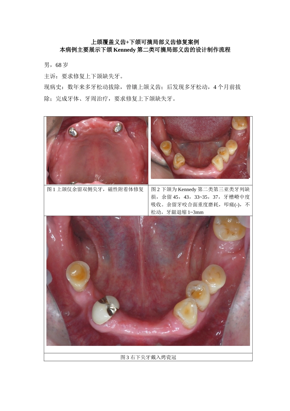 下颌Kennedy 第二类可摘局部义齿修复案例.docx_第1页
