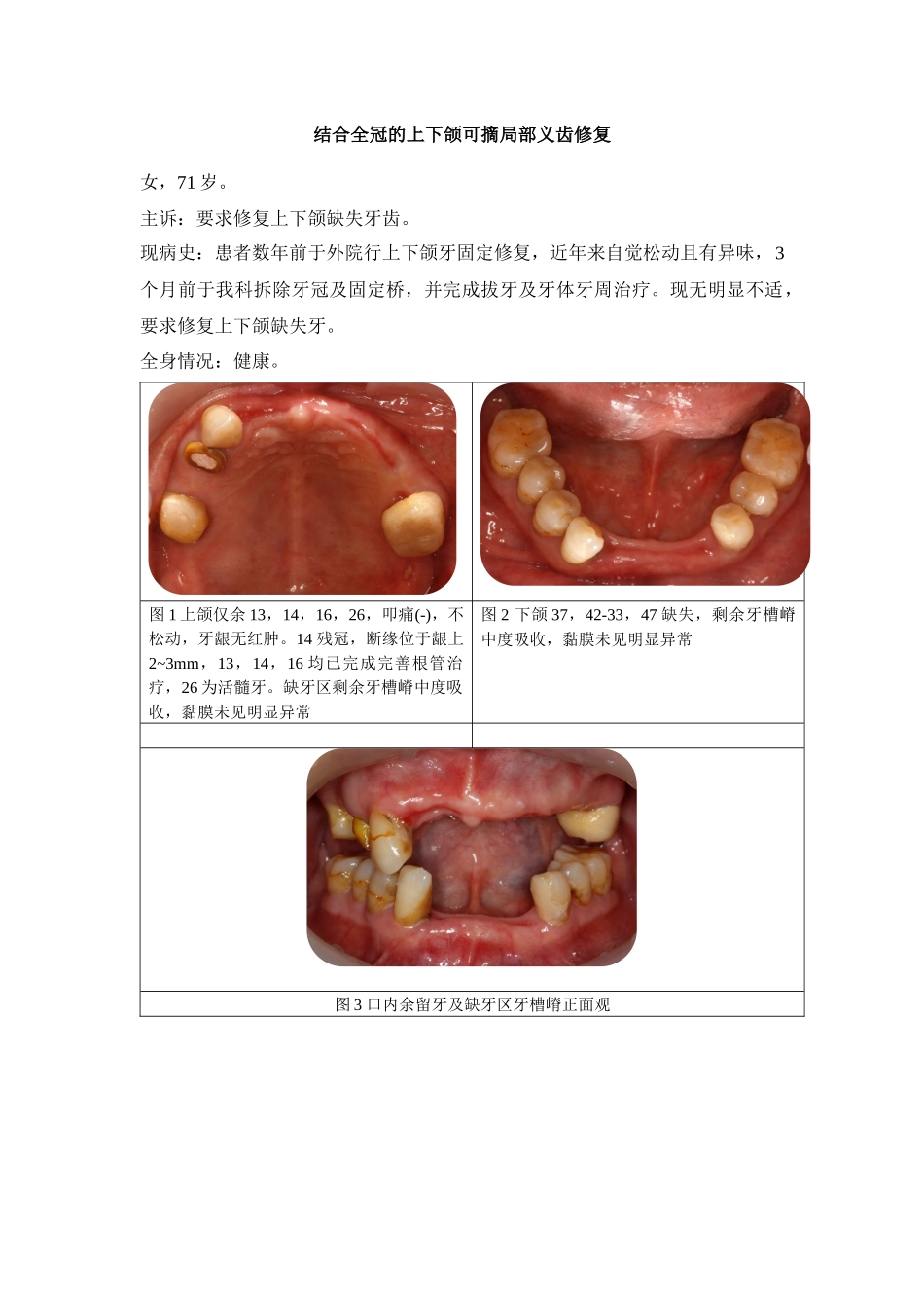 下颌Kennedy第四类可摘局部义齿修复案例.docx_第1页
