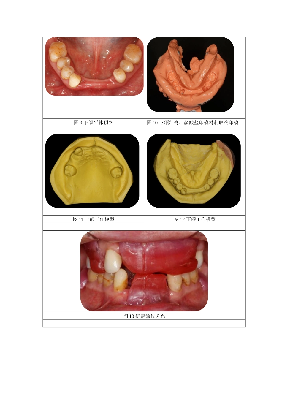 下颌Kennedy第四类可摘局部义齿修复案例.docx_第3页