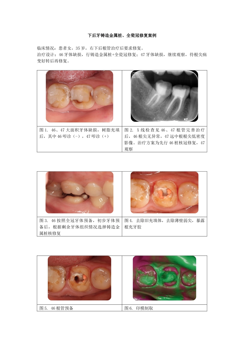 下后牙铸造金属桩、全瓷冠修复案例.docx_第1页