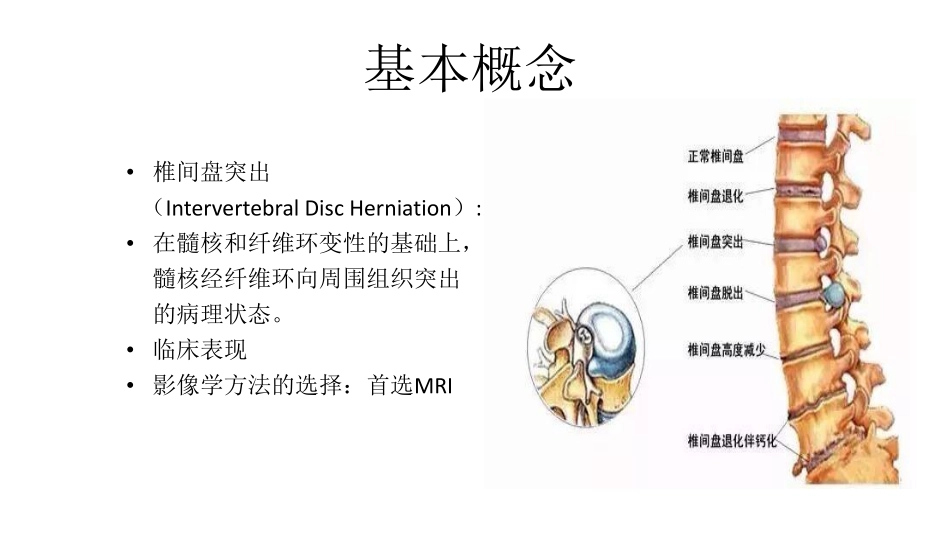 医学学科：(2.2.1)--椎间盘突出的影像学诊断.pdf_第2页