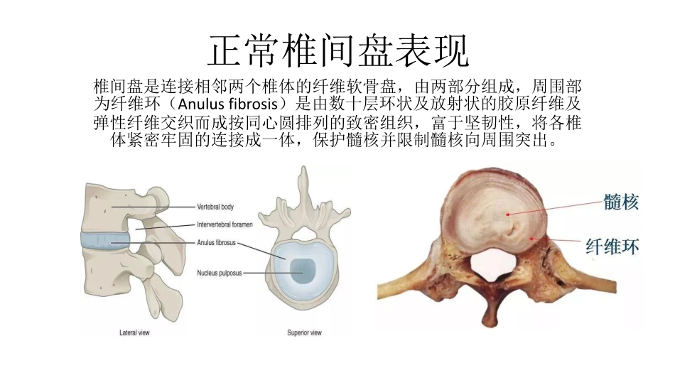医学学科：(2.2.1)--椎间盘突出的影像学诊断.pdf_第3页