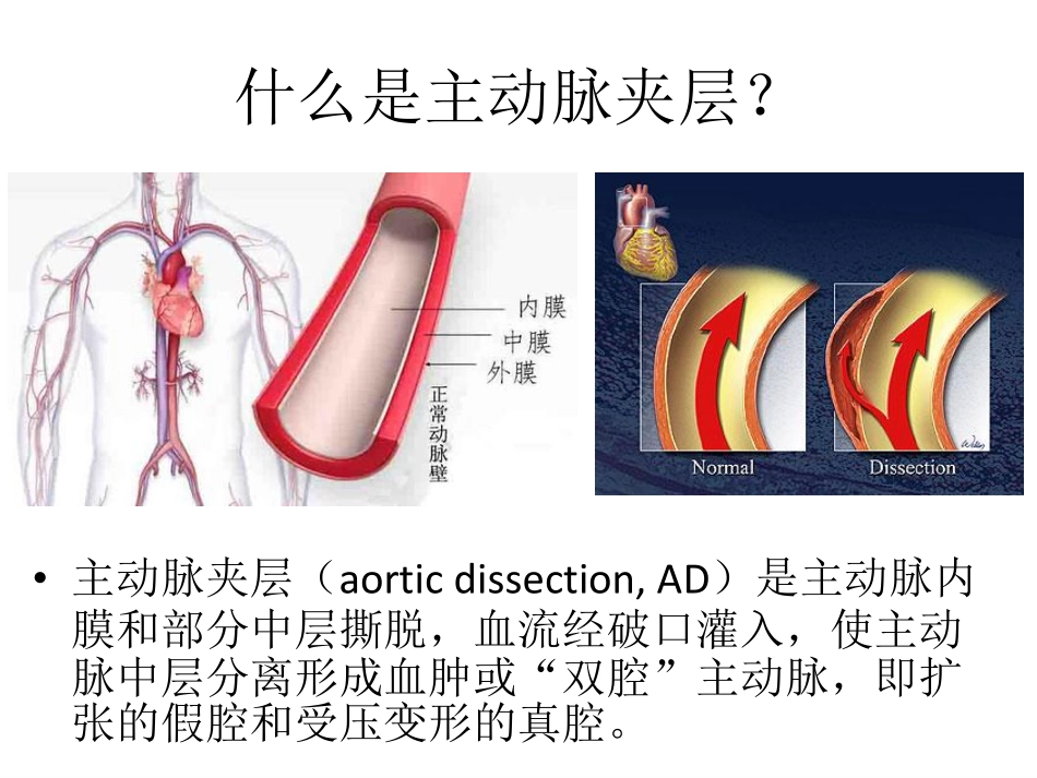 医学学科：(4.4.1)--主动脉夹层的影像学诊断.pdf_第2页