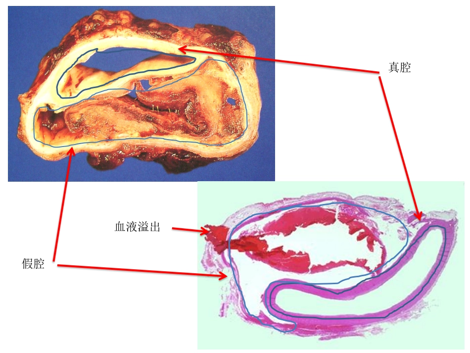 医学学科：(4.4.1)--主动脉夹层的影像学诊断.pdf_第3页