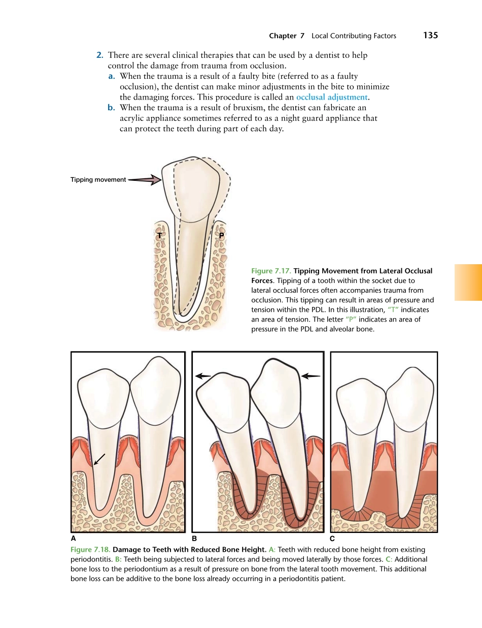 牙周2012Foundations of Periodontics for the Dental Hygienist _151-175.pdf_第3页