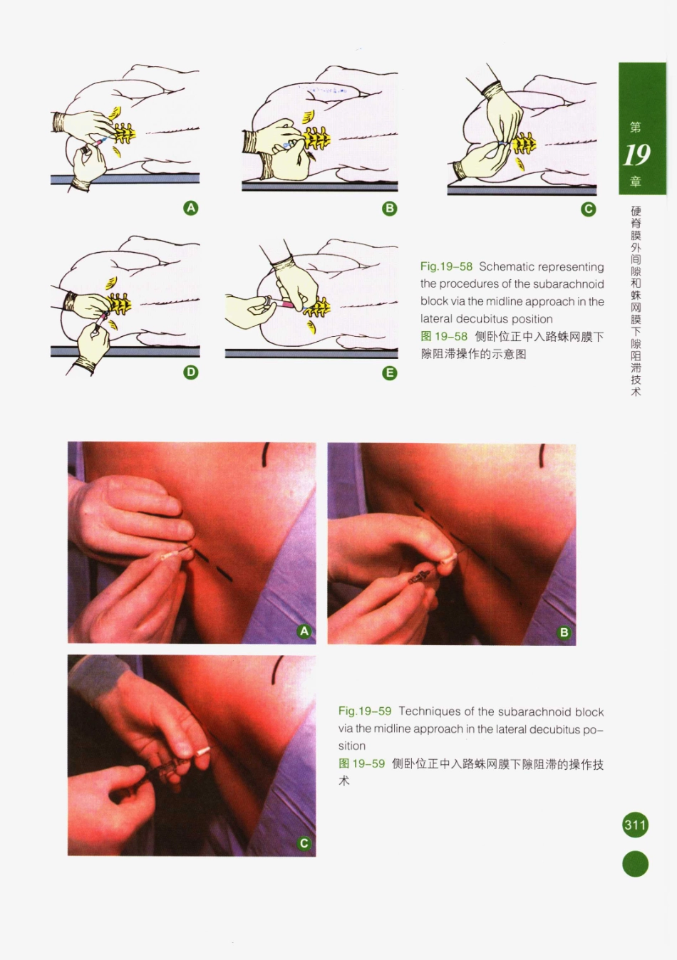 临床局部麻醉技术_326-350.pdf_第1页