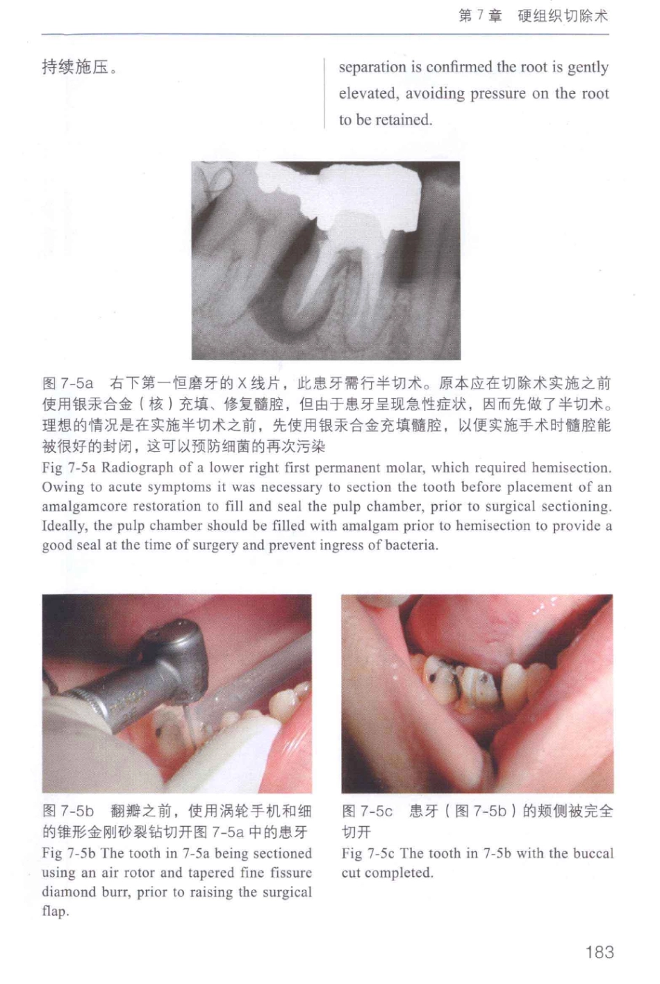 牙周手术临床指南 中英文对照_俞雪芬2013（彩图）_193-204.pdf_第1页